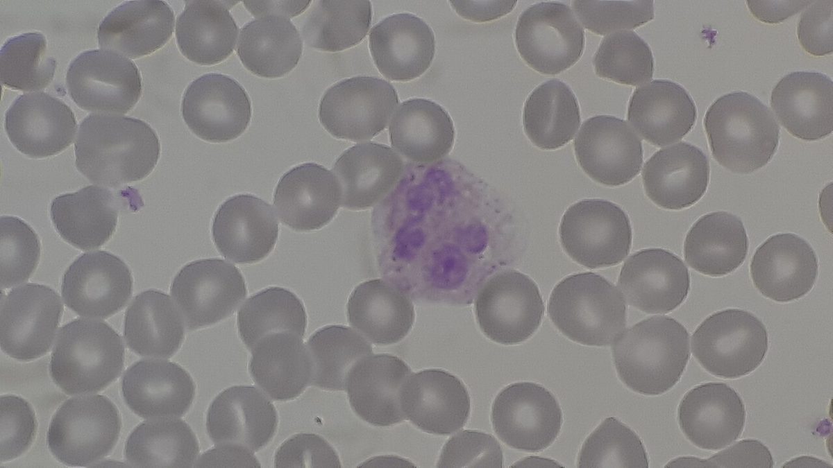 Microscope view of many pale round red blood cells, one larger purple-stained white cell with a lobed nucleus, and a few tiny purple platelets.