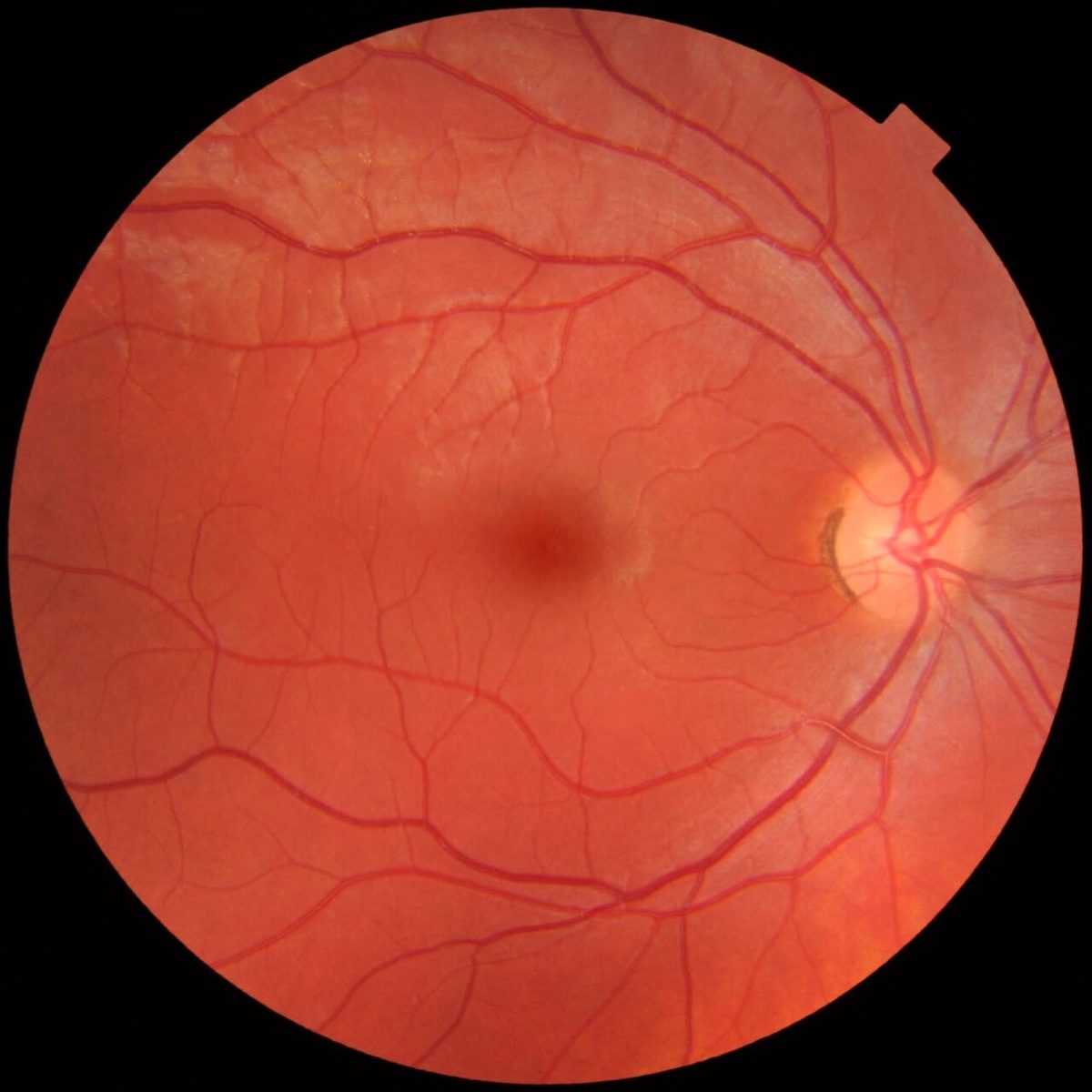 A round orange-red photo of the back of an eye, with blood vessels spreading from a pale yellow disc on the right and a darker spot in the centre.